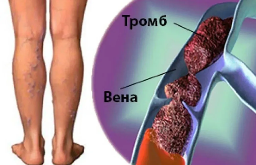 Названо 5 небезпечних ознак тромбозу глибоких вен